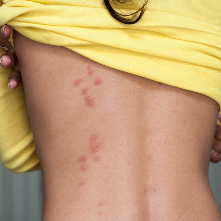 Bed Bugs - Bites grouped down a girls back